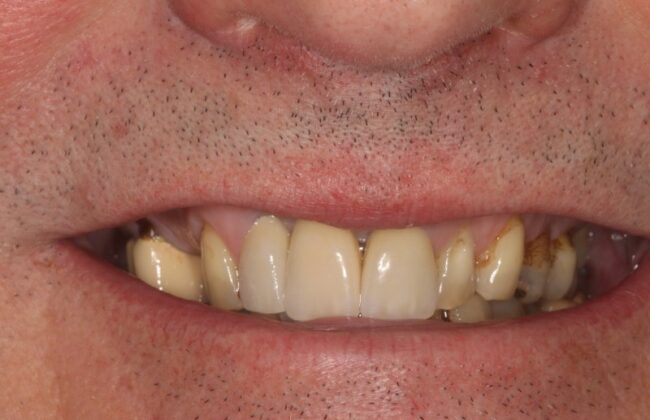 After (Teeth)