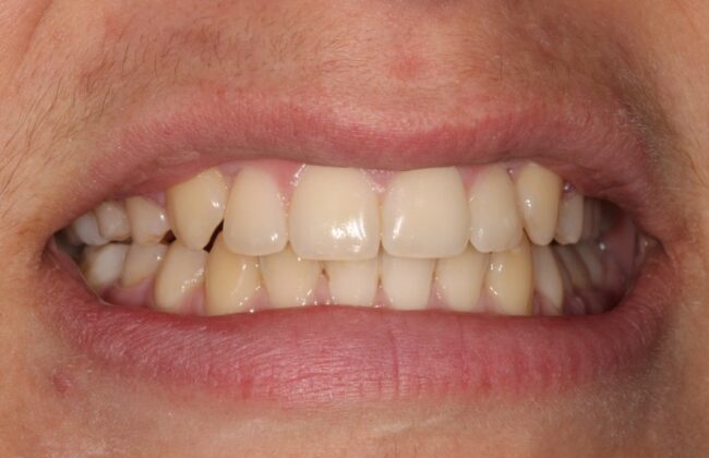 After (Teeth)