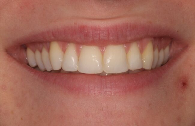 After (Teeth)
