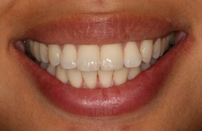 After (Teeth)