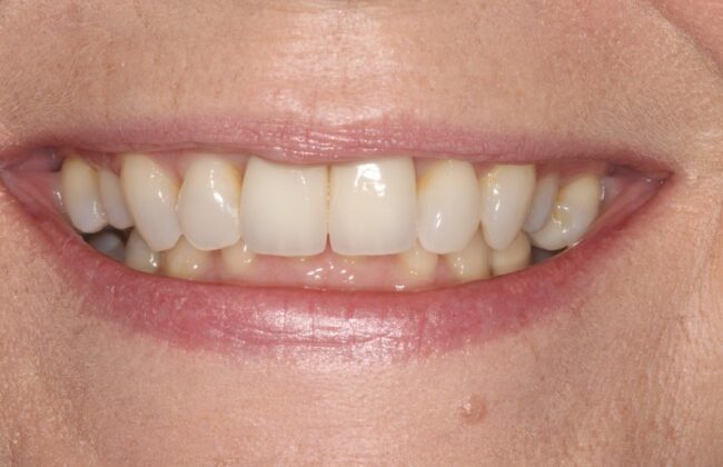 After (Teeth)