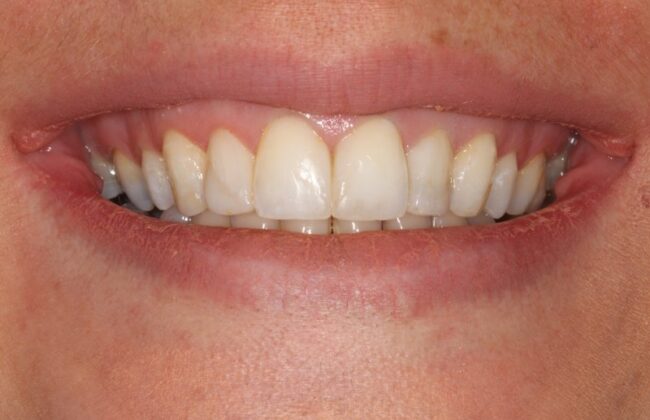 After (Teeth)
