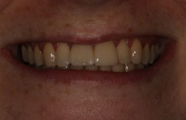 After (Teeth)