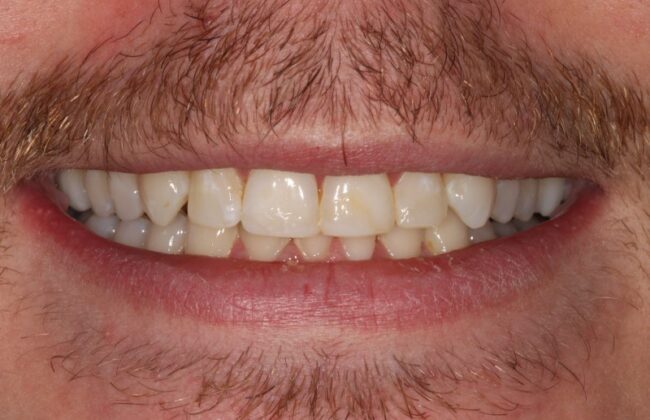 After (Teeth)