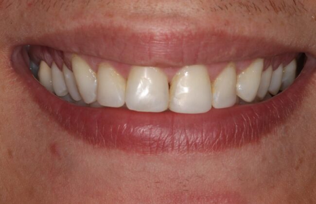After (Teeth)