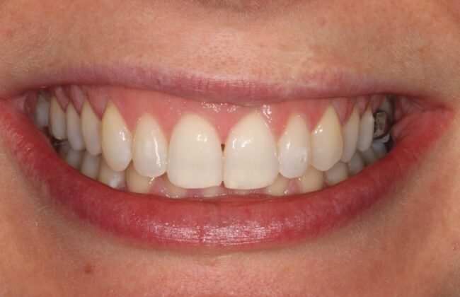 After (Teeth)