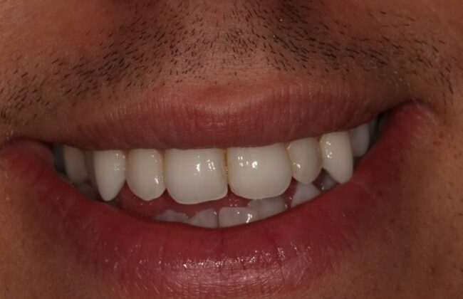 After (Teeth)