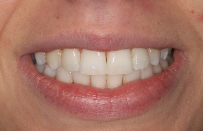 After (Teeth)