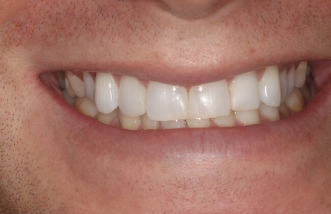 After (Teeth)
