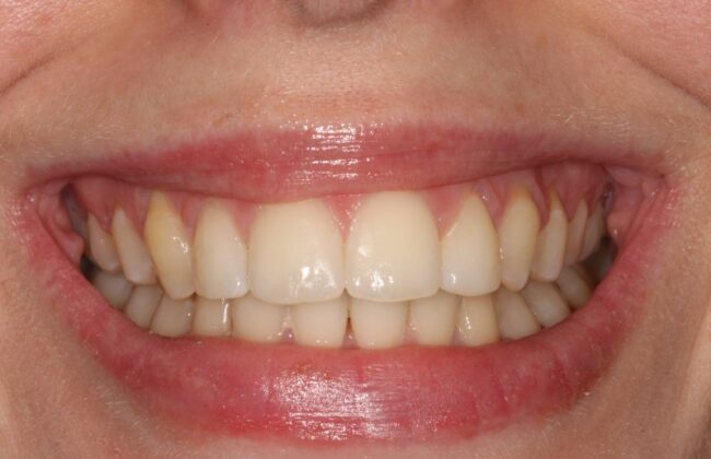 After (Teeth)