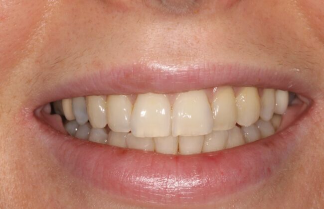 After (Teeth)
