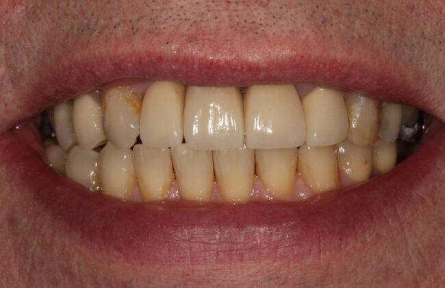 After (Teeth)