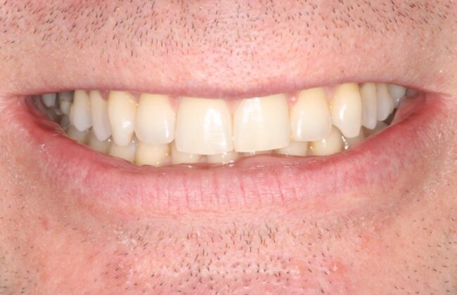 After (Teeth)