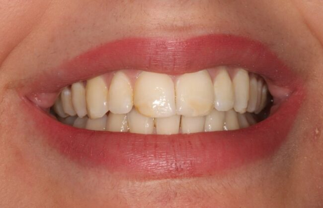 After (Teeth)
