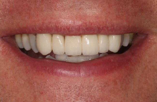 After (Teeth)