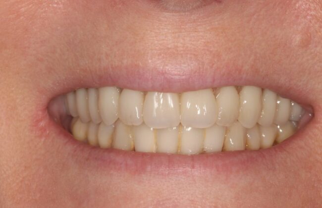 After (Teeth)