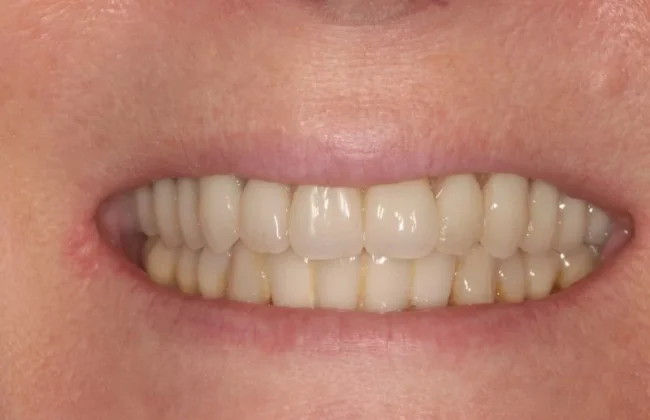 After (Teeth)