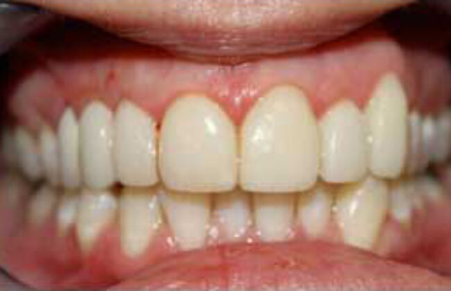 After (Teeth)