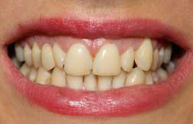 Before (Teeth)