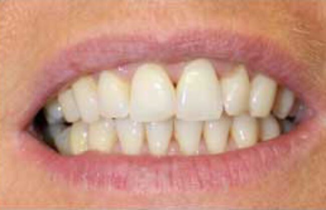 After (Teeth)