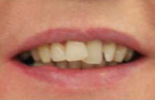 Before (Teeth)