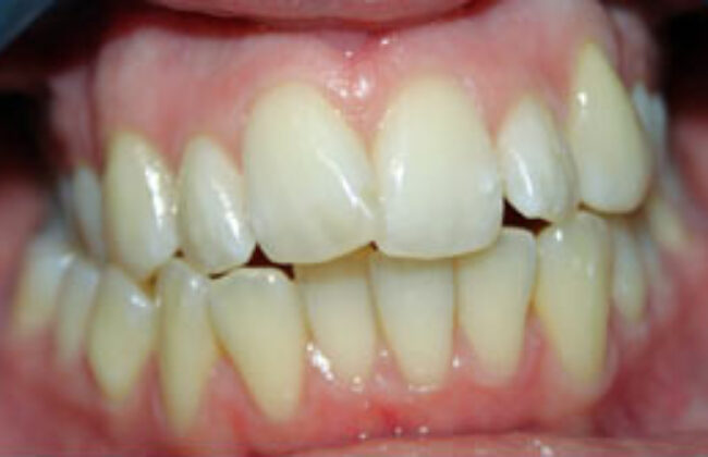 Before (Teeth)