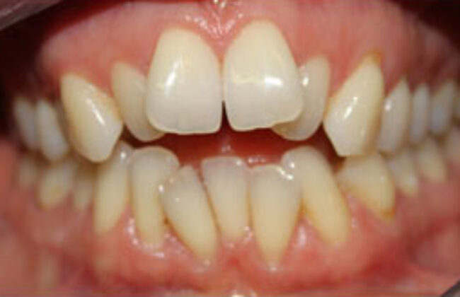 Before (Teeth)