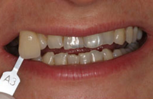 Before (Teeth)