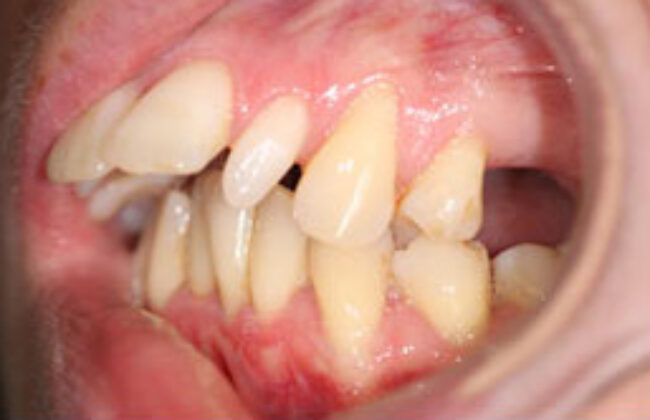 Before (Teeth)