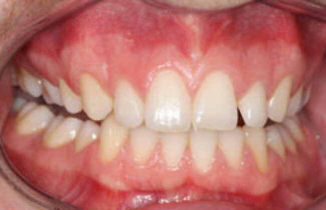 Before (Teeth)