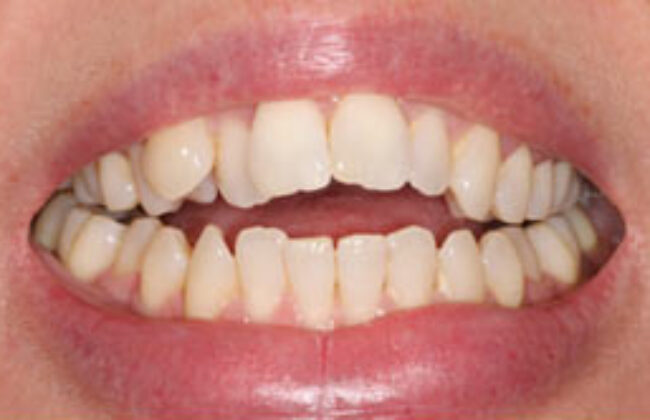 Before (Teeth)
