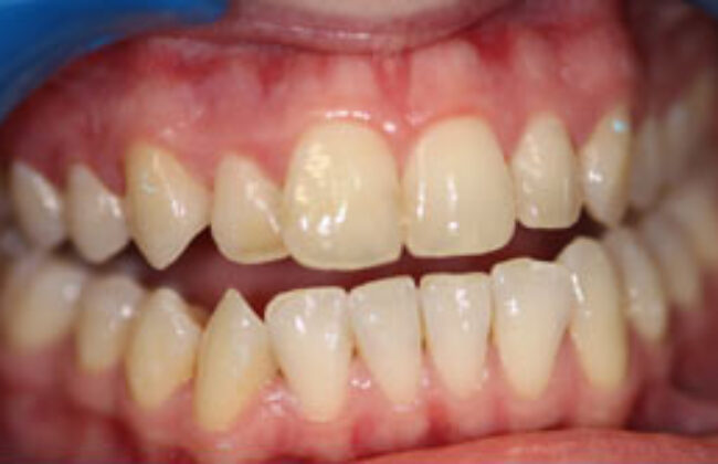 Before (Teeth)