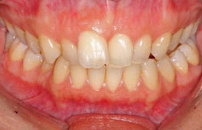 Before (Teeth)