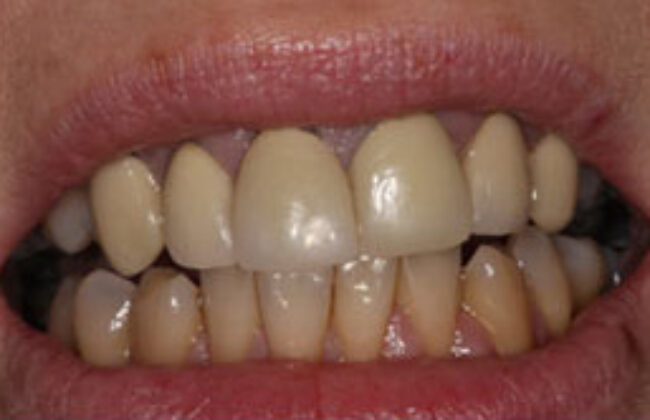 Before (Teeth)