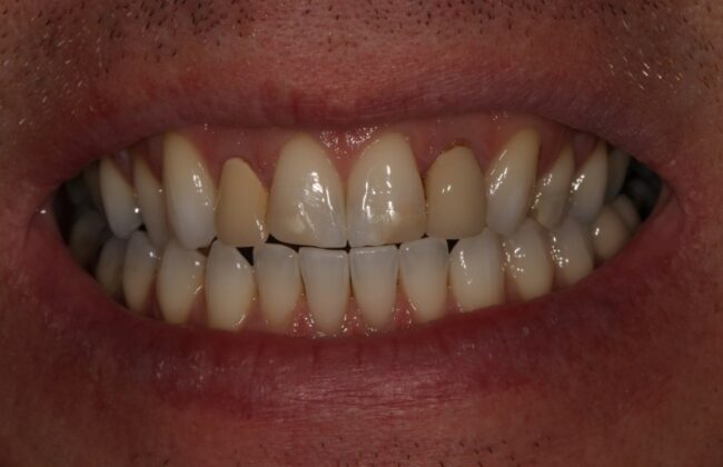 Before (Teeth)