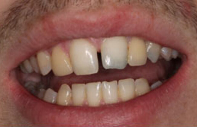 Before (Teeth)
