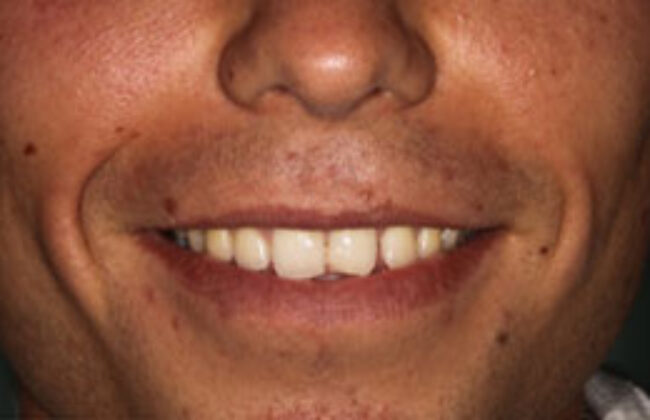 Before (Teeth)
