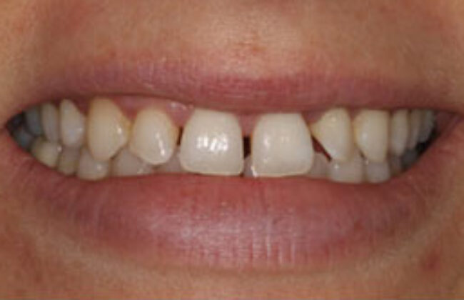 Before (Teeth)