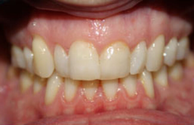 Before (Teeth)