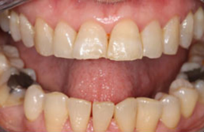 Before (Teeth)