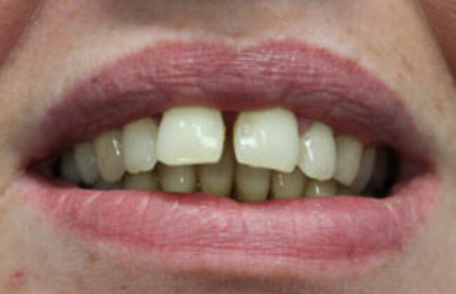 Before (Teeth)