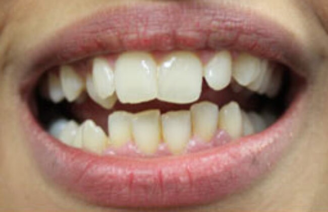 Before (Teeth)