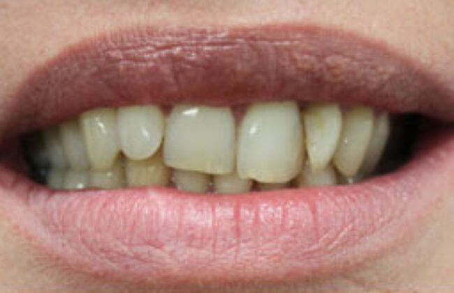 Before (Teeth)