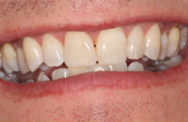 Before (Teeth)
