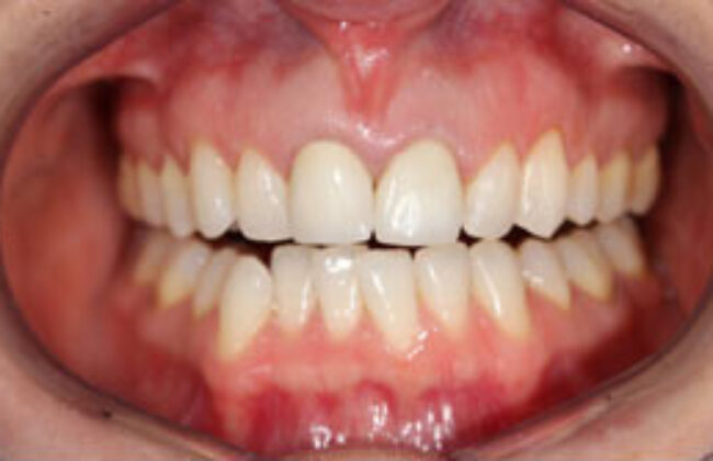Before (Teeth)