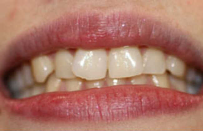 Before (Teeth)