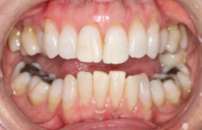 Before (Teeth)