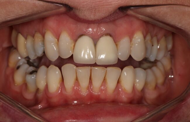 Before (Teeth)