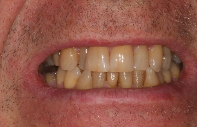 Before (Teeth)