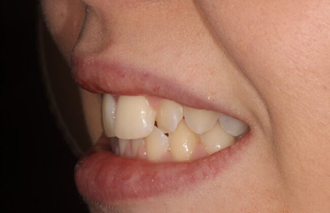 Before (Teeth)